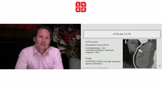 De plaats van PCSKinhibitie bij atherosclerotische stenose